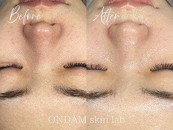 オンダム 南青山 表参道(ONDAM)/【毛穴の詰まり・開き】