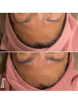 ファビリス 天王寺店(FAVILIS)/ACトリートメント3回/60代