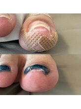 アーティネイルズ(Aaty Nails)/見た目も可愛い巻き爪ケアジェル