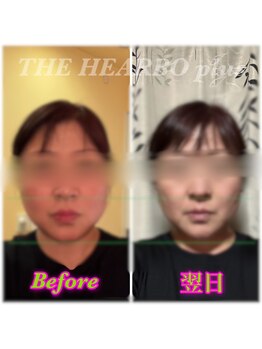 ハーボプラス(THE HEARBO plus)/初回 翌日でも