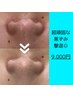 【ハイドラ＆ヒト幹】角栓浮かし＆ハイドラ洗浄＋ヒト幹100％導入＋パック