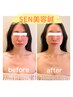 【小顔・ほうれい線気になる方へ】SEN美容鍼45分コース