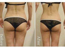 ラフォス×痩身マッサージ90分｛ 2ヶ月 4回 ｝