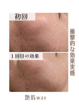 アリュール(ALLURE)/【艶肌waxの施術効果】