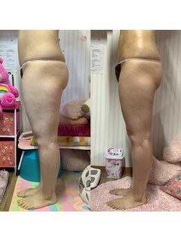 ポノ(Pono)/【痩身】サイドアングル下肢
