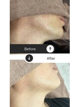 ルアナ(Luana)/ヒゲ脱毛でツルツルのお肌に♪