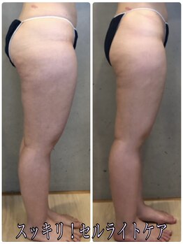 エクセレントビューティーサロン 艶(EN)/VENUSDIVA　凸凹セルライト撃退