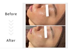 アブニールブリヨン/ハーブピーリング　Before After