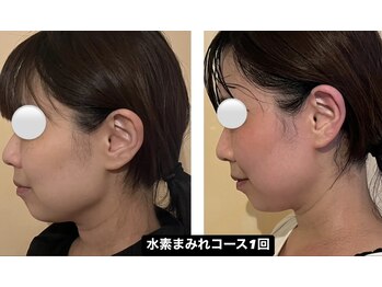 ヨサパーク ミモザ 三軒茶屋店(YOSA PARK Mimosa)/水素とハーブの効果で痩せ若く！