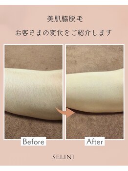 セリーニ(Selini)/20年の実績☆この時期人気の脱毛