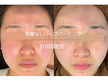 ライフ美容整体院 恵比寿(Life美容整体院)/顔の赤みケア