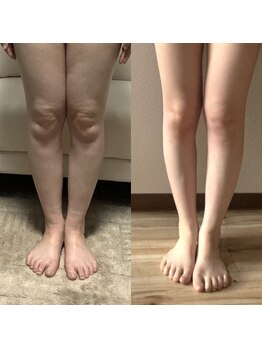 アノネ(Anone.)/光電子アイテム症例