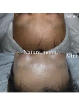 ナチュールムーン(Nature moon.)/ハーブピーリング　after