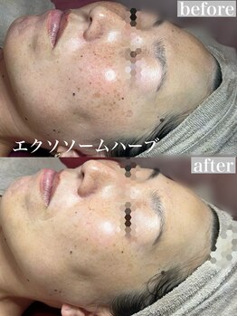 エミュローズ 段原店(Nm' Rose)の写真/毛穴を目立たなくしたい!肌荒れ・ニキビが気になる方に|剥離なし!肌の再育成◇ハーブピーリング◇
