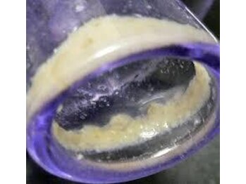 メディカルエステ ユウ(Yuu)/ごっそり取れました！