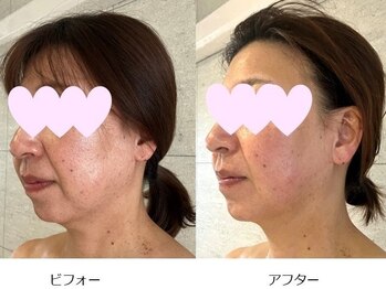 ベルメイク(BELLE MAKE)/美整コルギ☆ビフォーアフター横