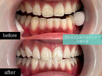 ホワイトニングカフェ 博多駅前店(WhiteningCafe)/◎歯のホワイトニング施術写真◎
