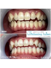ホワイトニングサロン 名古屋駅店/【ホワイトニング施術例】