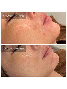 ビビ(VIVI)/ハーブで通うたびきれいな肌に