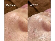 フォーシーズ(FOR SEEDS)の雰囲気（毛穴集中コース♪どこのハーブを使うかでエイジングケア近道！！）