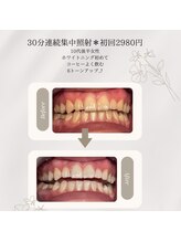 プラスビーセルフ(+b self)/ホワイトニングビフォーアフター