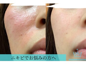 リメイクビューティークリニック(REMAKE BEAUTY CLINIC)/赤み、肌荒れ改善