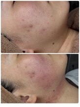 ヘラ(HERA)/小顔・二重顎悩みにはインモード