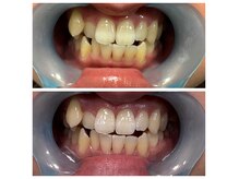 エステサロン オパール(OPALE)の雰囲気（セルフホワイトニング！歯の汚れを取り除く歯の色で印象変わる）
