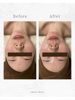 サロンモア(salon More)/陶肌トリートメント