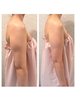 ビューティースタジオ韓美 新宿御苑前/二の腕脂肪燃焼×引き締め