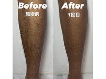 アイリス(IRIS)/あし脱毛Before After
