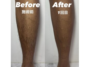 アイリス(IRIS)/あし脱毛Before After