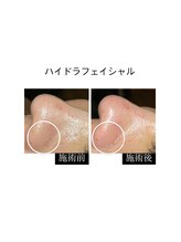 プライベートサロンイムエ(Private Salon IMME.)/ハイドラフェイシャル 