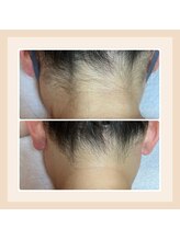 フェリス(FELIZ)/人気の高いうなじ脱毛