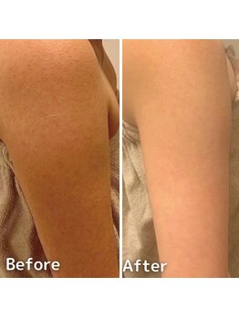 エミルカ(EMILUCA)/ハーブピーリング二の腕ツルツル