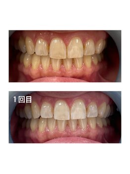 スカイ(Sky)/ホワイトニング