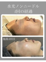 サイ(Sai)/赤ら顔改善