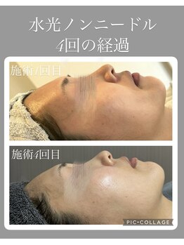 サイ(Sai)/赤ら顔改善