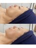 【1ヶ月以内割引】小顔矯正×モデリングパック
