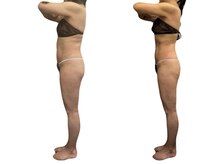 アールユー ギンザ(Ryou ginza)/セルゼロ　ビフォーアフター