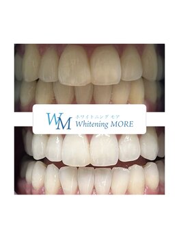 ホワイトニング モア(Whitening MORE)/ビフォーアフター