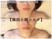 ラ ドゥーサ(La Dusa)/たるみライン改善☆理想Vライン