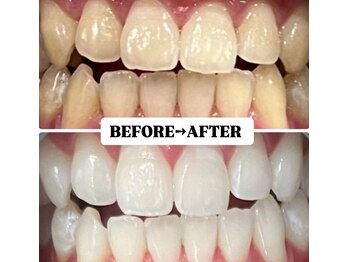 ホワイトニングサロン 豊中/Before&After美白ホワイトニング