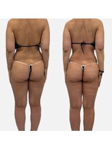 ラヴィ(Ravi)/美尻美脚コース60分