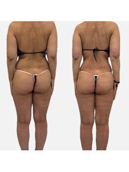 ラヴィ(Ravi)/美尻美脚コース60分