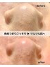 【毛穴徹底洗浄×超保湿くすみケア】ピーリング+洗浄吸引+高保湿泡パック70分