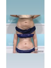 ビーナスアイスブルー(Venus ICE BLUE)/衝撃のビフォーアフター