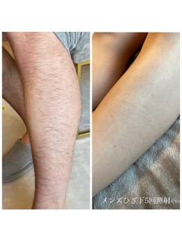 エクラ(eclat)/メンズひざ下脱