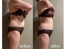 メロウ(me: llow)/ハイパーナイフEX/恵比寿エステ