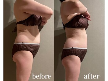 メロウ(me: llow)/ハイパーナイフEX/恵比寿エステ